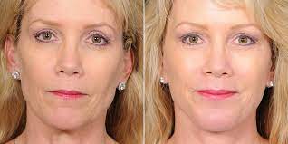 Make use of the Facelift Santa Barbara price ranges and instantly replenish your face post thumbnail image