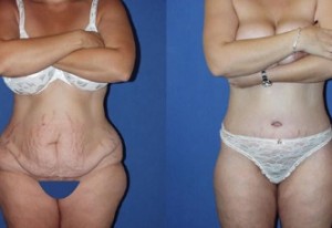 Flaunt Your Beach Bod with a Tummy Tuck in Miami post thumbnail image